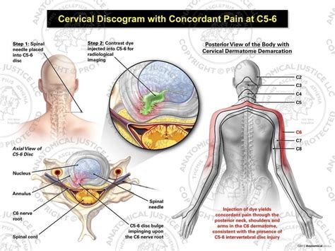 Cervical Disc Disorder