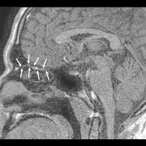 Olfactory Nerve Mri