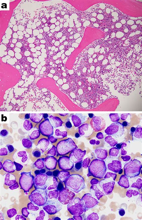 Figure2.A bone marrow biopsy (a) and smear (b). A bone marrow biopsy... | Download Scientific ...