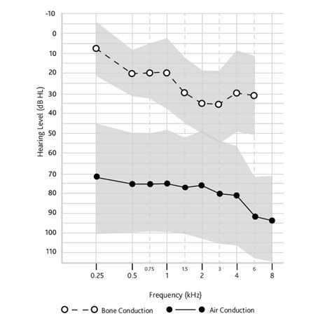 Mean bone conduction and air conduction thresholds for the study... | Download Scientific Diagram