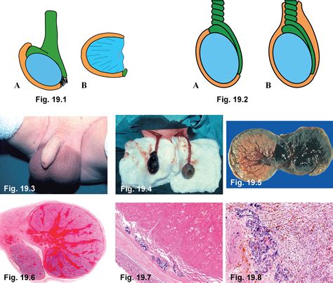 Scrotal Ligament