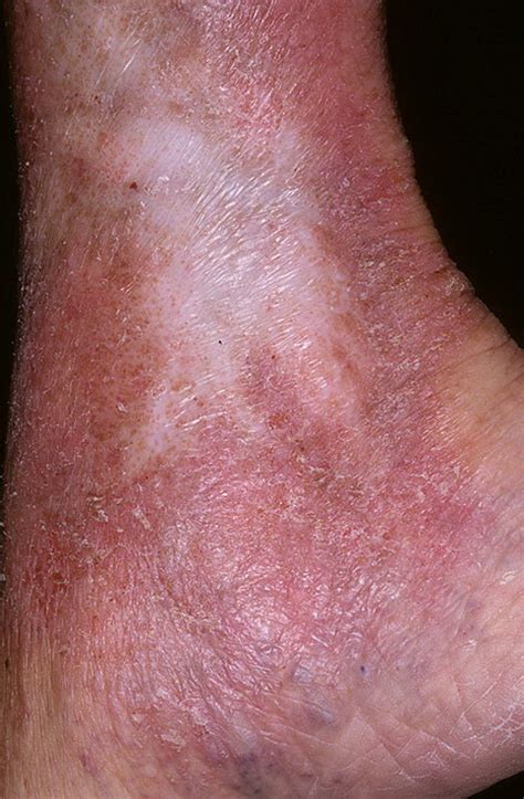 Stasis Dermatitis on Legs Pictures – 174 Photos & Images / illnessee.com