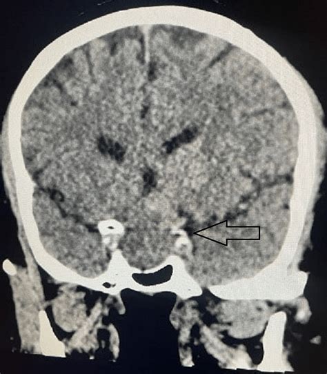 Pituitary Apoplexy After a Major Abdominal Surgery: A Case Report | Cureus