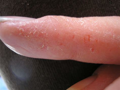 Eczema on One Finger | Dorothee Padraig South West Skin Health Care