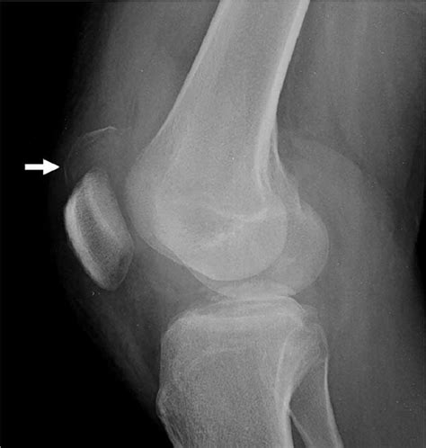 Quadriceps Tendon Tear Mri