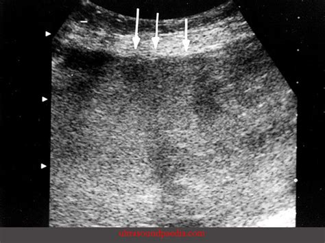 Placenta accreta – ULTRASOUNDPAEDIA