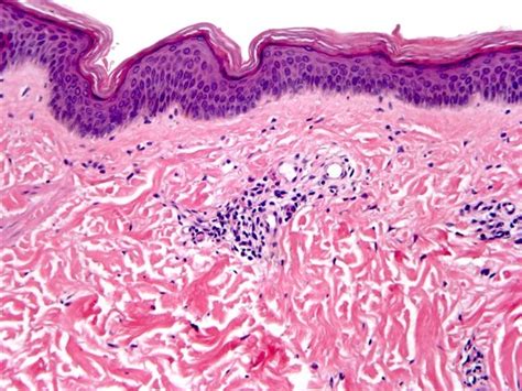 Pigmented Purpuric Eruptions (all variants: Schamberg’s disease [capillaritis], Purpura ...