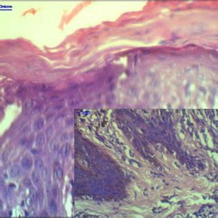 Histology of lichen nitidus – psoriasiform hyperplasia present. | Download Scientific Diagram