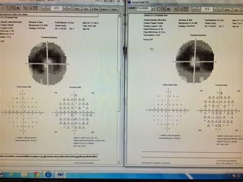 Plaquenil Retinopathy Screening Requirements: Are You Up to Date on the New Standards? - Eyedolatry