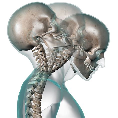 Whiplash, Cervical Strain, Cervical Sprain - ShimSpine