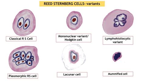 REED- STERNBERG CELLS - Pathology Made Simple