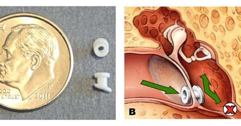 Guide: Not all kids need ear tubes to relieve fluid