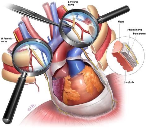 Phrenic Nerve Injury During Cardiac Surgery: Mechanisms, Management and Prevention - Heart, Lung ...