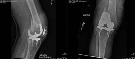 Periprosthetic Patella Fracture