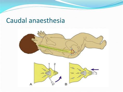 PPT - Regional anaesthesia in children PowerPoint Presentation, free download - ID:2990963