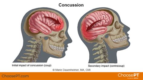 Guide | Physical Therapy Guide to Concussion | Choose PT