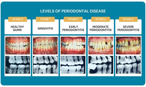 How to Prevent and Manage Gum Disease - Dental Care Stamford