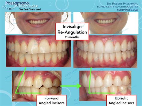 Forward Angulation Resolved with Invisalign and IPR - Passamano ...