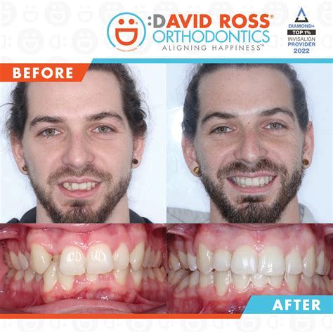 5 Facts About Clear Aligners | David Ross Orthodontics