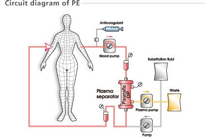 Plasmapheresis | Asahi Kasei Medical Co., Ltd.