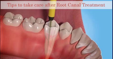 TIPS TO CARE AFTER A ROOT CANAL TREATMENT