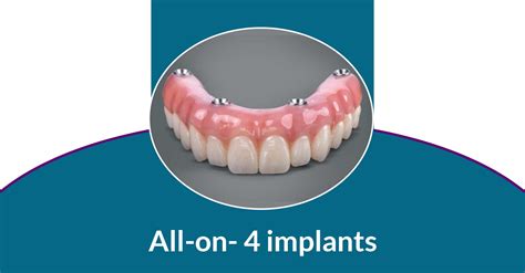 All on 4 Dental Implants Near Me | Glendale Family Dentist