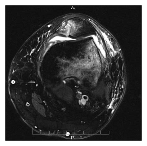 Axial cut of a T2 weighted MRI obtained at follow-up which demonstrates ...