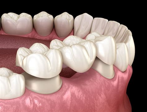 The 5 less invasive alternatives to dental implants | Dental Centre ...