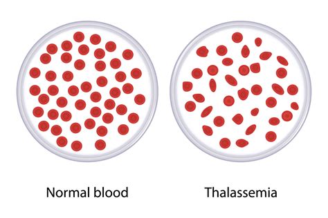 World Thalassemia Day 2021 - Medically Speaking