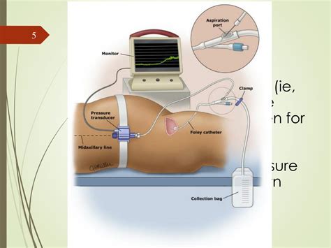 PPT - ABDOMINAL COMPARTMENT SYNDROME PowerPoint Presentation, free download - ID:4564110