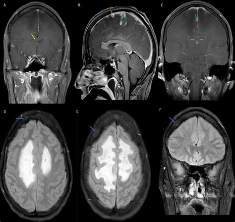 Cerebral syphilitic gumma presenting with intracranial gumma and pathologic vertebrae fractures ...