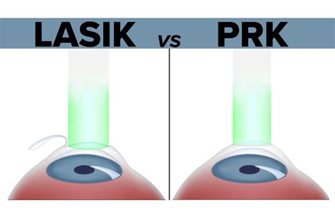 Prk Vs Lasik Differences Pros Cons And What To Expect - Asking List