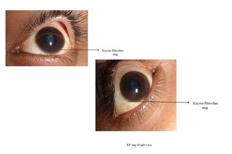 Wilsonâ s disease | International Journal of Clinical & Medical Images