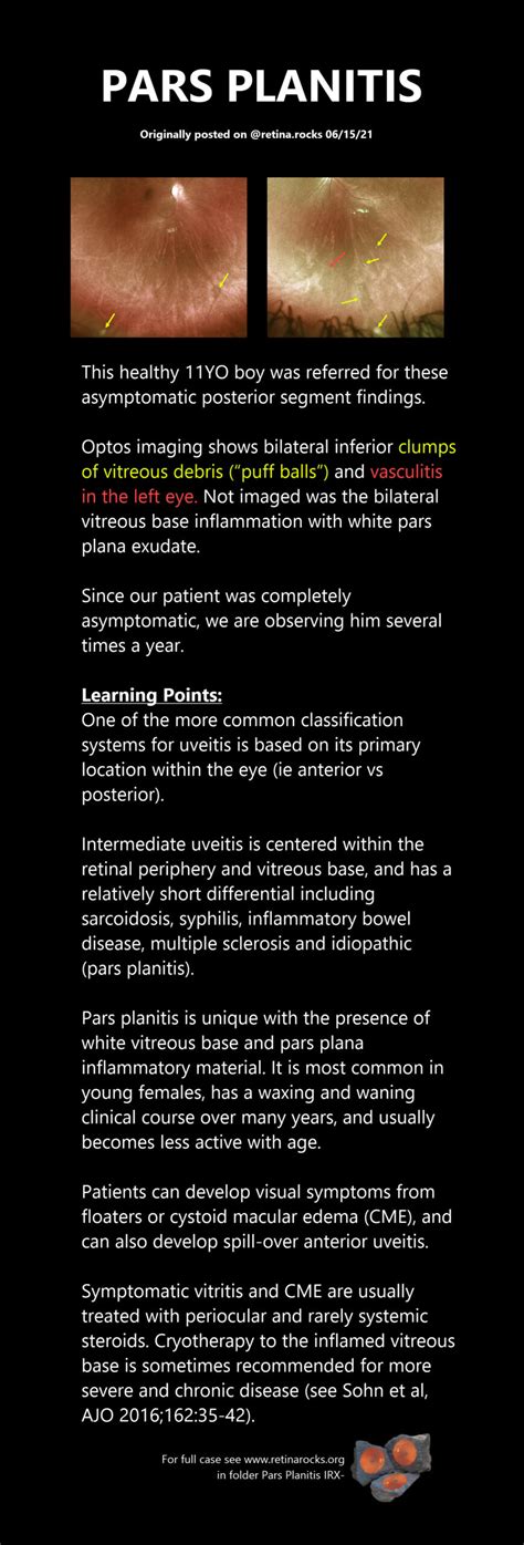 Inflammatory Disorders > Pars Planitis - Retina Rocks