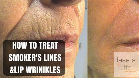 How to treat upper lip wrinkles and smoker's lines - YouTube