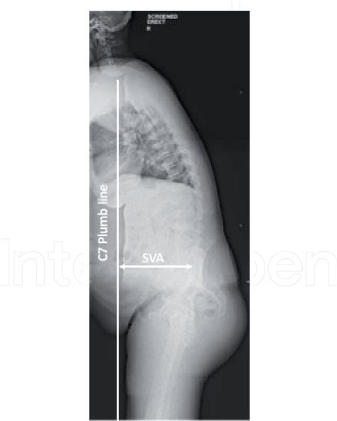 Figure 3 from The Functional Effects of Adult Spinal Deformity and the Effectiveness of Surgery ...