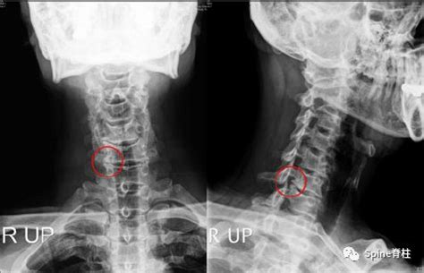 干货！颈椎 X 线片给我们诊断带来哪些提示？ - 好医术早读文章 - 好医术-赋能医生守护生命