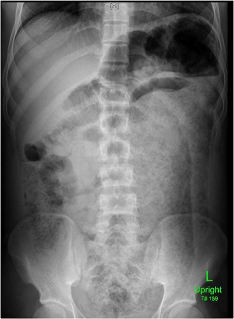 Normal Abdominal X Ray / Child with punctate opacities in the colon | Contemporary ...