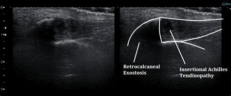 Ultrasound Images of Insertional Achilles Tendinopathy - Ankle, Foot and Orthotic Centre