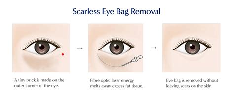 Eye Bag Removal Surgery For The Elderly: Is It Recommended? | Dream Plastic Surgery