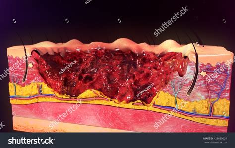 Third Degree Burn 3d Illustration - 428689624 : Shutterstock