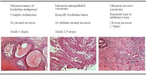 Serous Ovarian Cancer Histology - CancerWalls