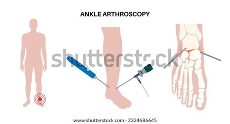 63 Laparoscopy Benefits Images, Stock Photos, 3D objects, & Vectors | Shutterstock