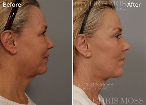 Facelift & Neck Lift Results - Before and After