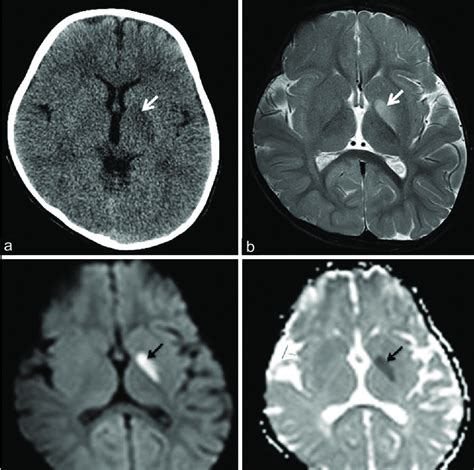 (a) Computed tomography brain showing hypodensity of the left globus... | Download Scientific ...