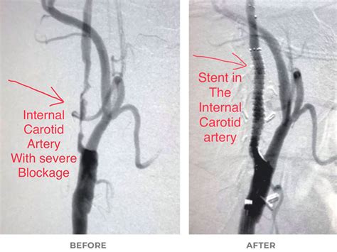 Carotid Artery Disease, Stroke, Transient Ischemic Attacks - Conditions ...