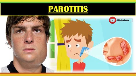 PAROTITIS | ETIOLOGY OF PAROTITIS | CLINICAL MANIFESTATIONS OF ...