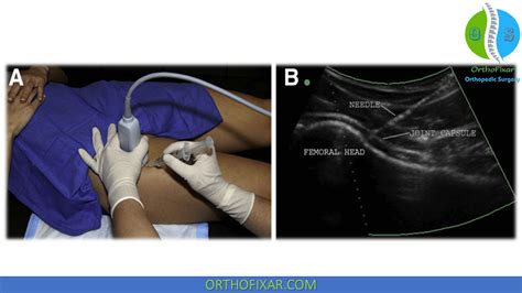 Hip Injection Technique | OrthoFixar 2025