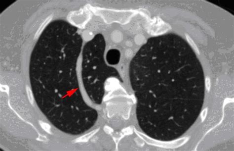 ABC Radiology Blog: Azygos lobe