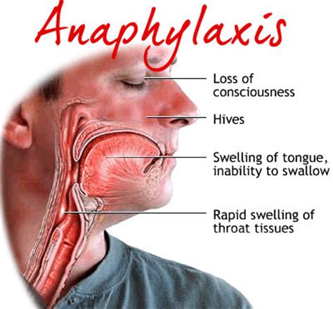 Anaphylactic shock | News | Dentagama